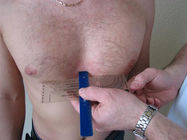 лечение деформации груди