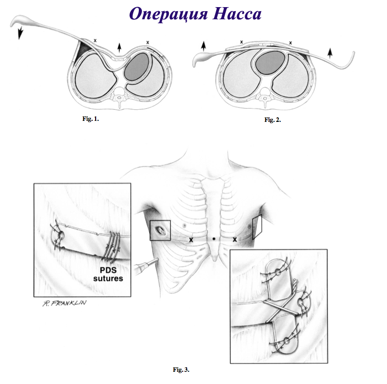 лечение деформации груди и операция Насса