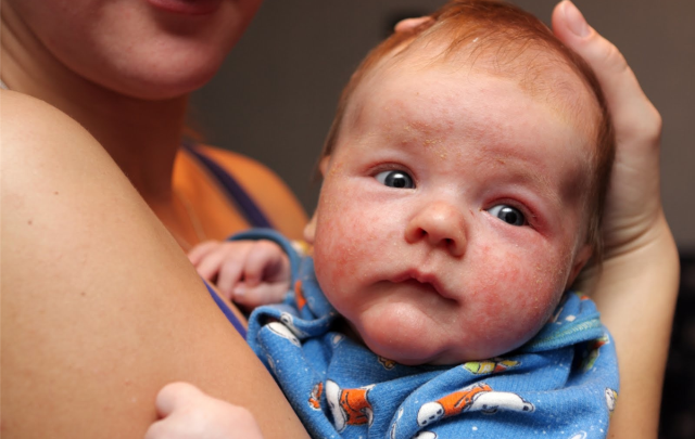 Діатези у дітей: