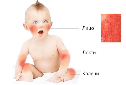 диагностика диатеза у ребенка