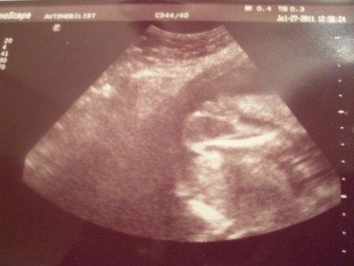 Стать дитини з фото з УЗД - Все для мам про дітей