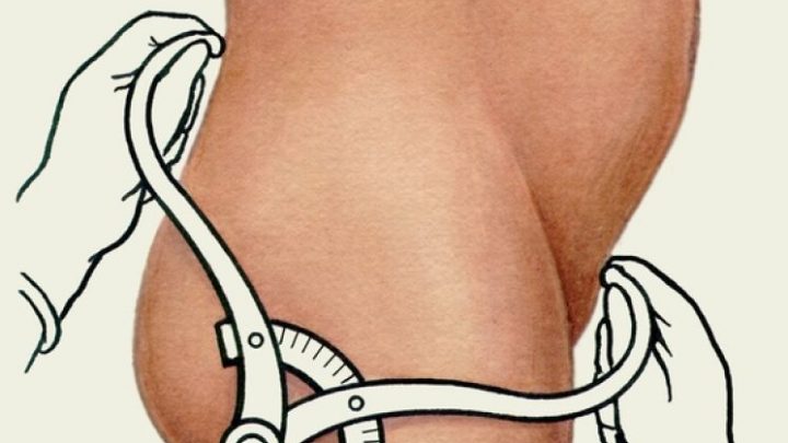 Вузький таз при вагітності