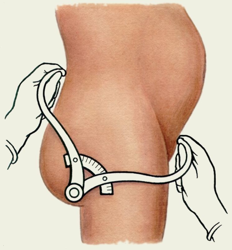 узкий таз при беременности и родах