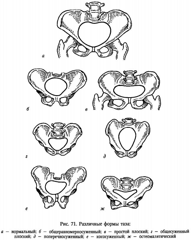 виды узкого таза